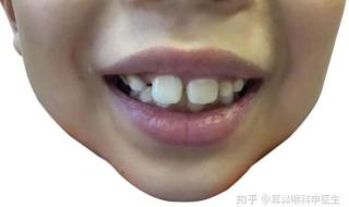 腺样体面容初期图片